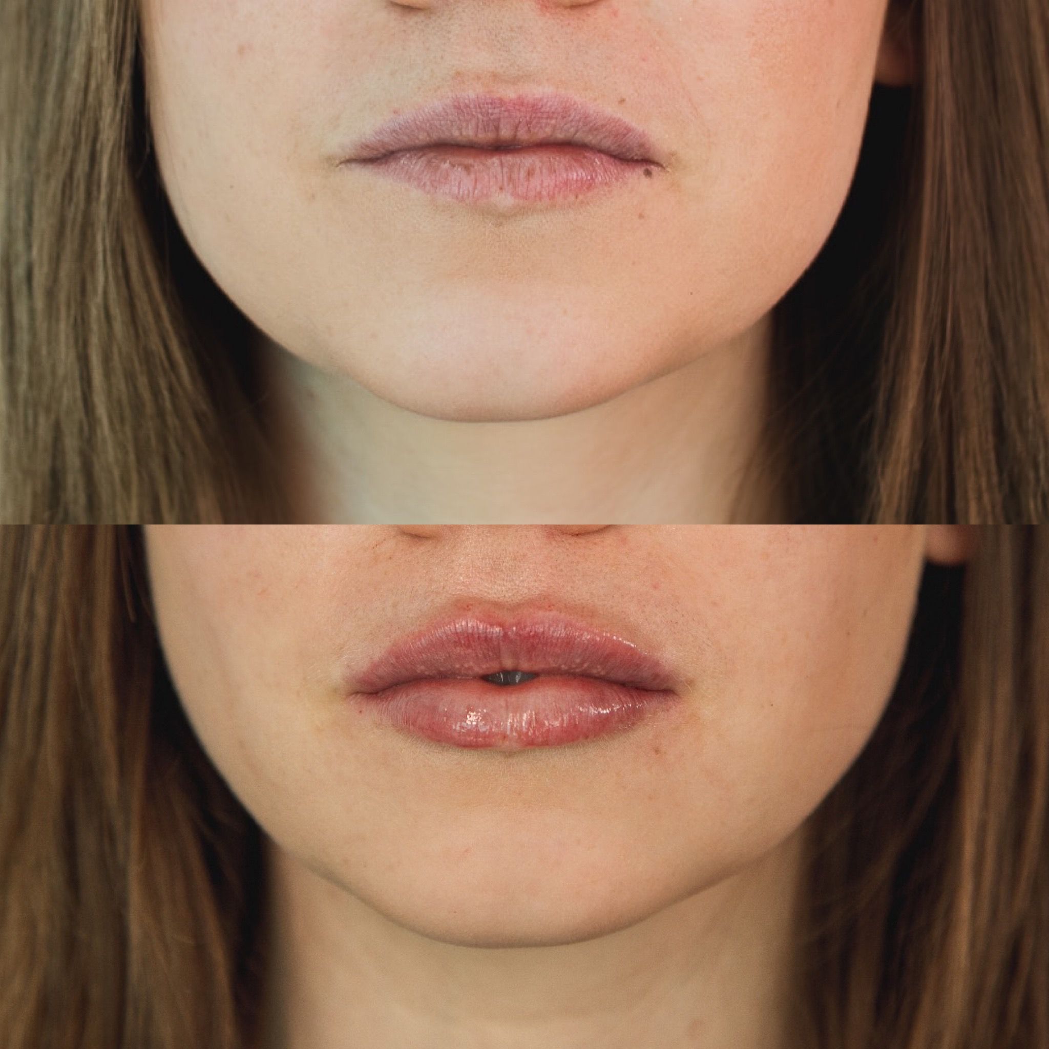 Ihre Ästhetik: Hyaluron-Filler für die Lippen bei Heilpraktikerin Nicole Bruhn