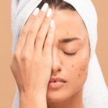 Die besten Tipps zur Hautpflege bei Winterakne