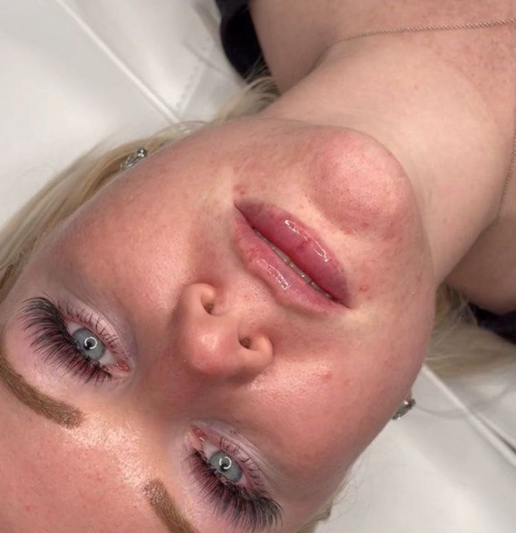 Foto: Lippenunterspritzung in Dithmarschen.