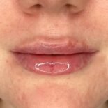 Lippenunterspritzung in Dithmarschen - natürliche Schönheit durch Heilpraktikerin Jana Möller