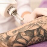 Wie man ungeliebte Tattoos wieder los wird