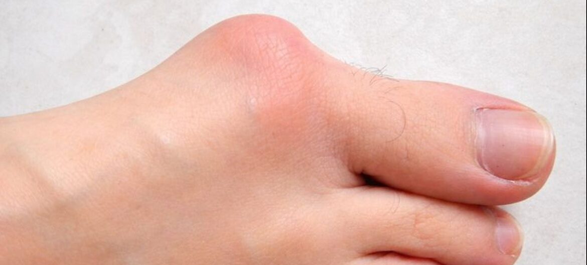Hallux Valgus